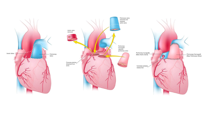 the-ross-procedure-aortic-valve-replacement